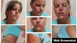 Mabel Páez, periodista de ICLEP, muestra las lesiones ocasionadas por los asaltantes (Foto tomada de ICLEP)